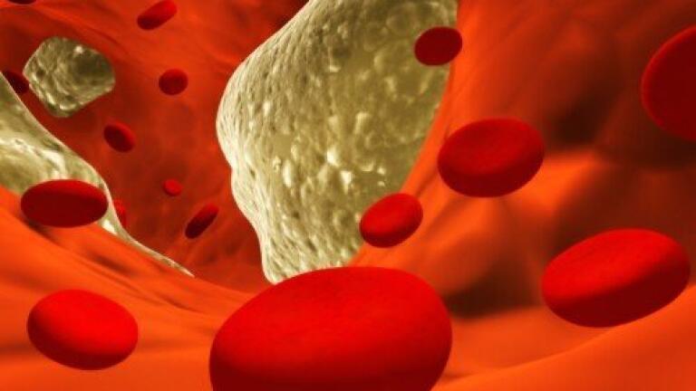 Air pollution can affect 'good' cholesterol leading to stroke and heart attack