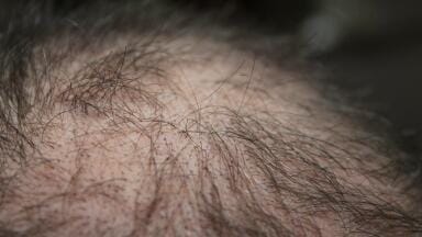 Could Air Pollution Make You Bald?