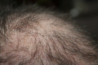 Could Air Pollution Make You Bald?