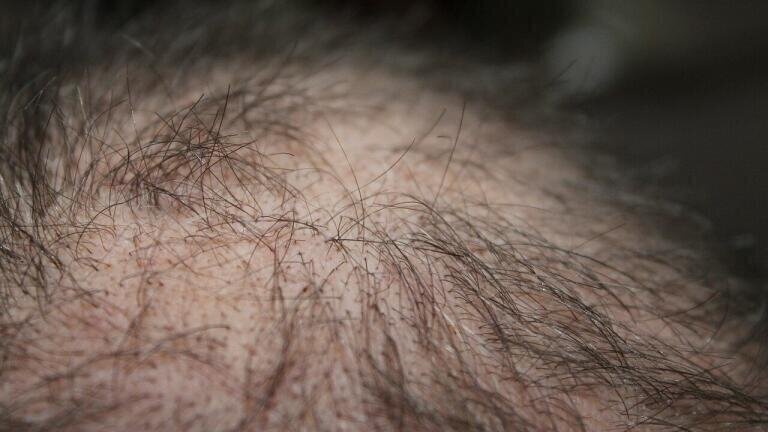Could Air Pollution Make You Bald?